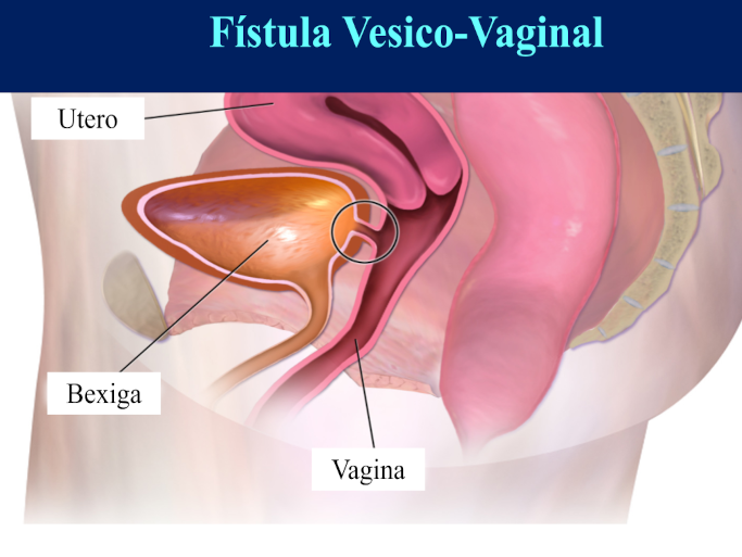 Fístula Urinária <h2 class='post_subtitle' style='text-align: center; font-size: 18px; margin-bottom: 28px;'>Fístula Urinária – Fistula Vaginal (Fístula Vésico-Vaginal)</h2>
