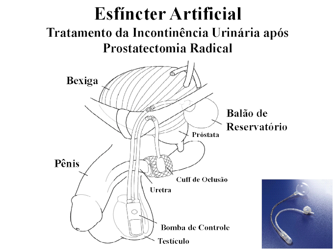 Tratamento da Incontinência Urinária em Homens após Prostatectomia Radical por Câncer de Próstata