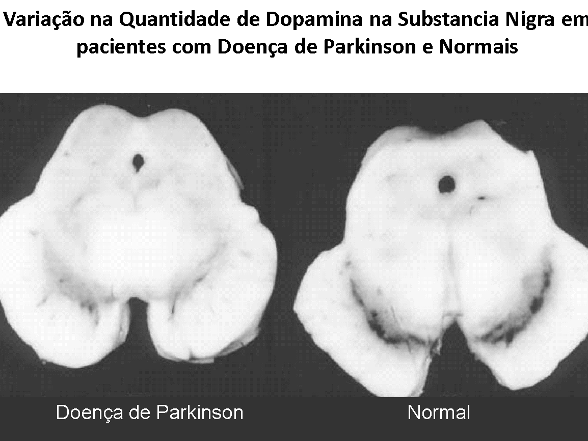 Ooforectomia bilateral e aumento do risco da doença de Parkinson