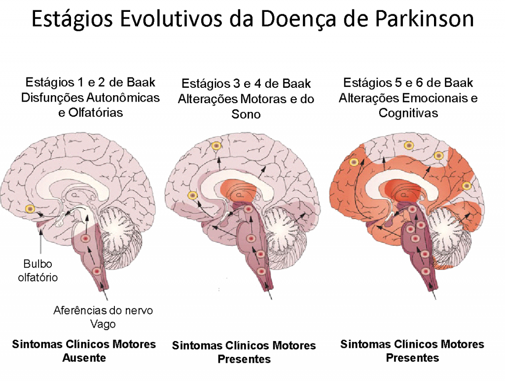 Ooforectomia bilateral e aumento do risco da doença de Parkinson